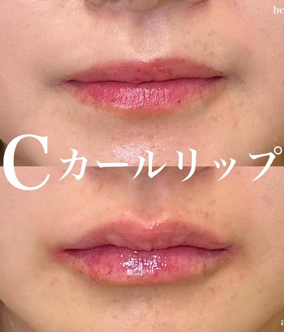Cカールリップの症例写真