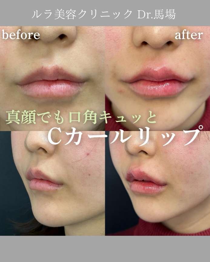 Cカールリップの症例写真