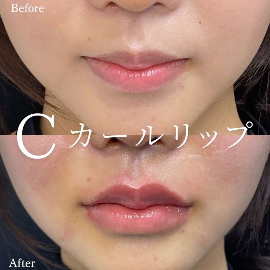 Cカールリップの症例写真