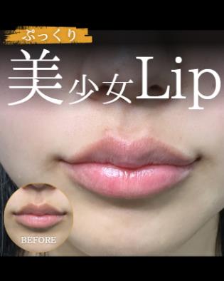 Cカールリップの症例写真