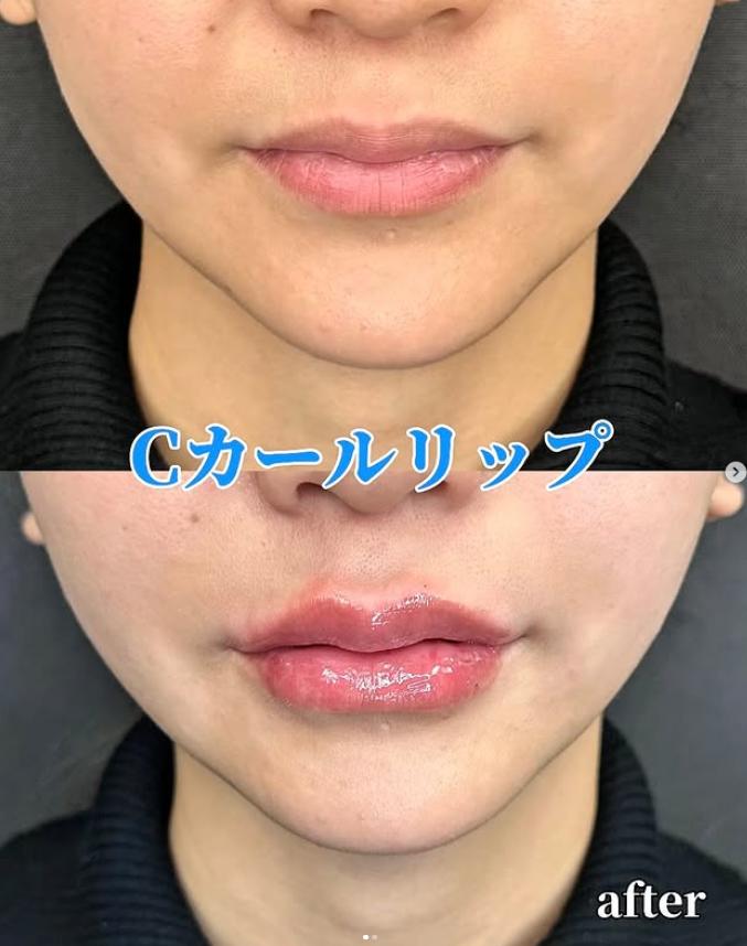 Cカールリップの症例写真