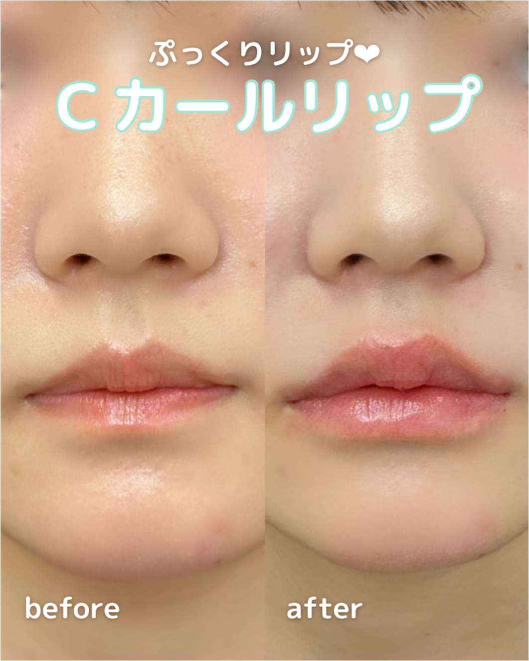 Cカールリップの症例写真