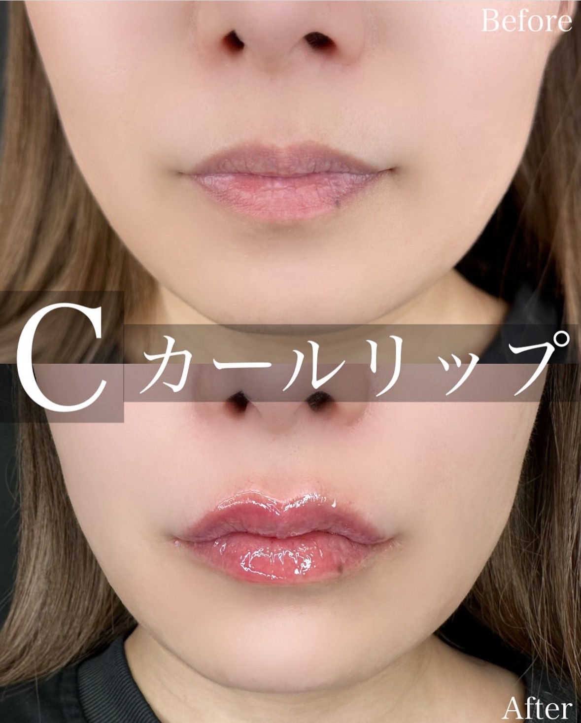 Cカールリップの症例写真