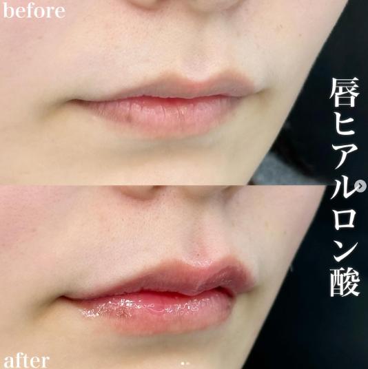 Cカールリップの症例写真