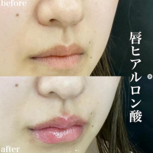 Cカールリップの症例写真