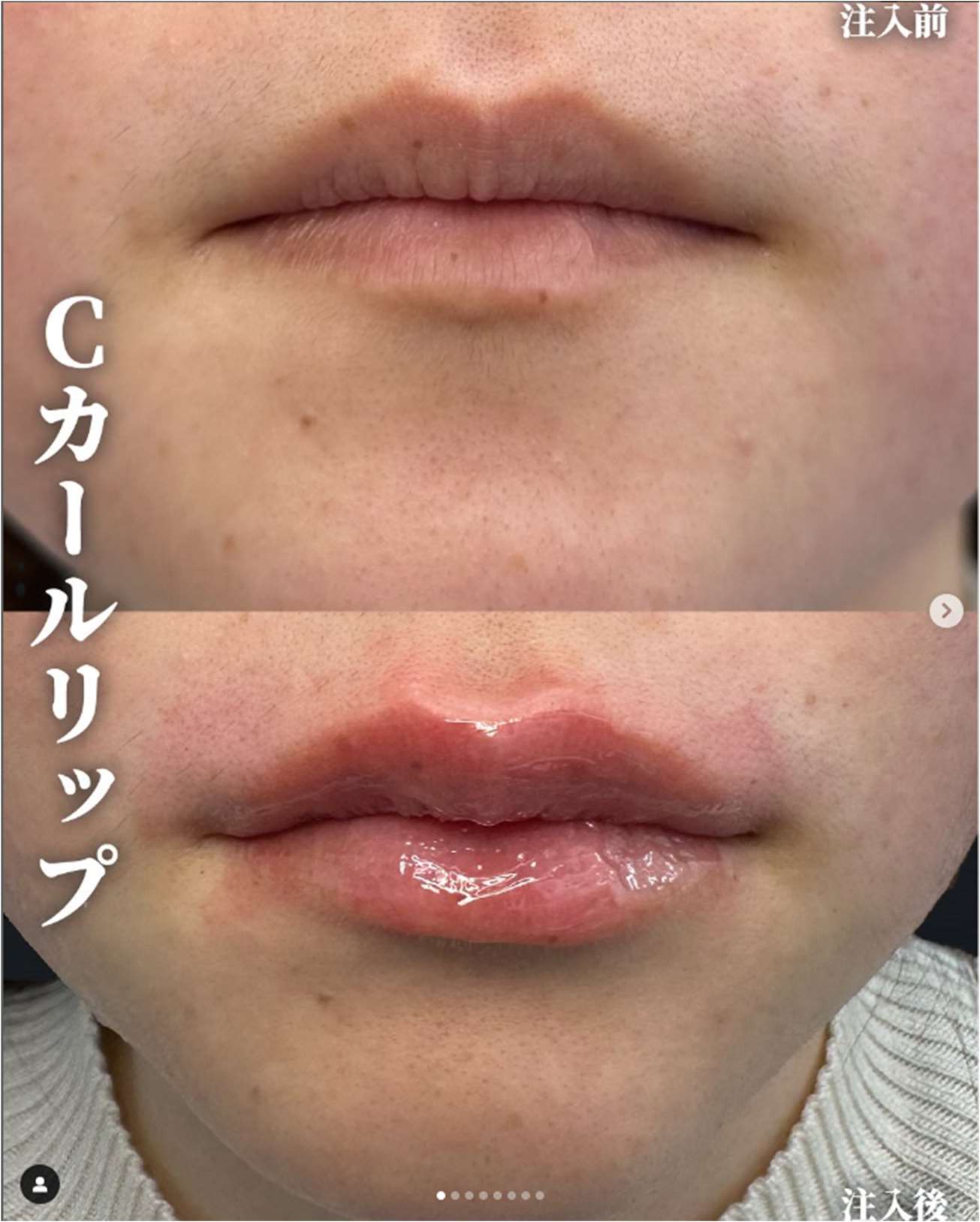 Cカールリップの症例写真