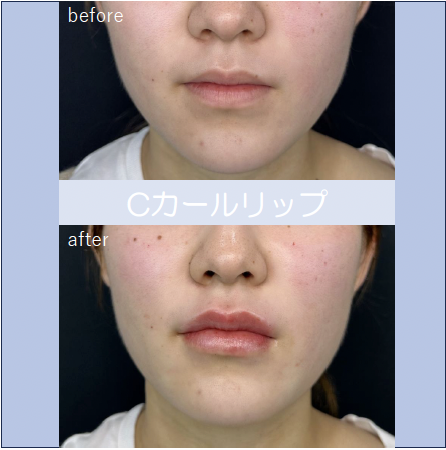 Cカールリップの症例写真