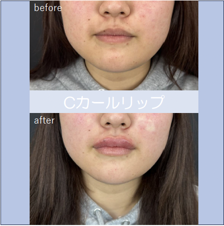 Cカールリップの症例写真