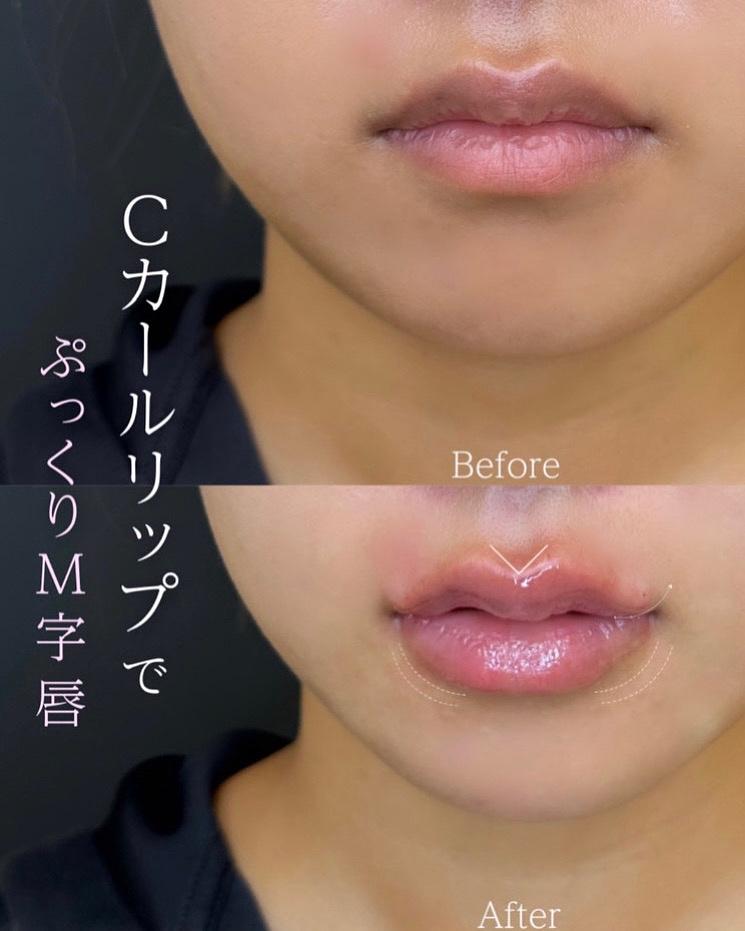 Cカールリップの症例写真