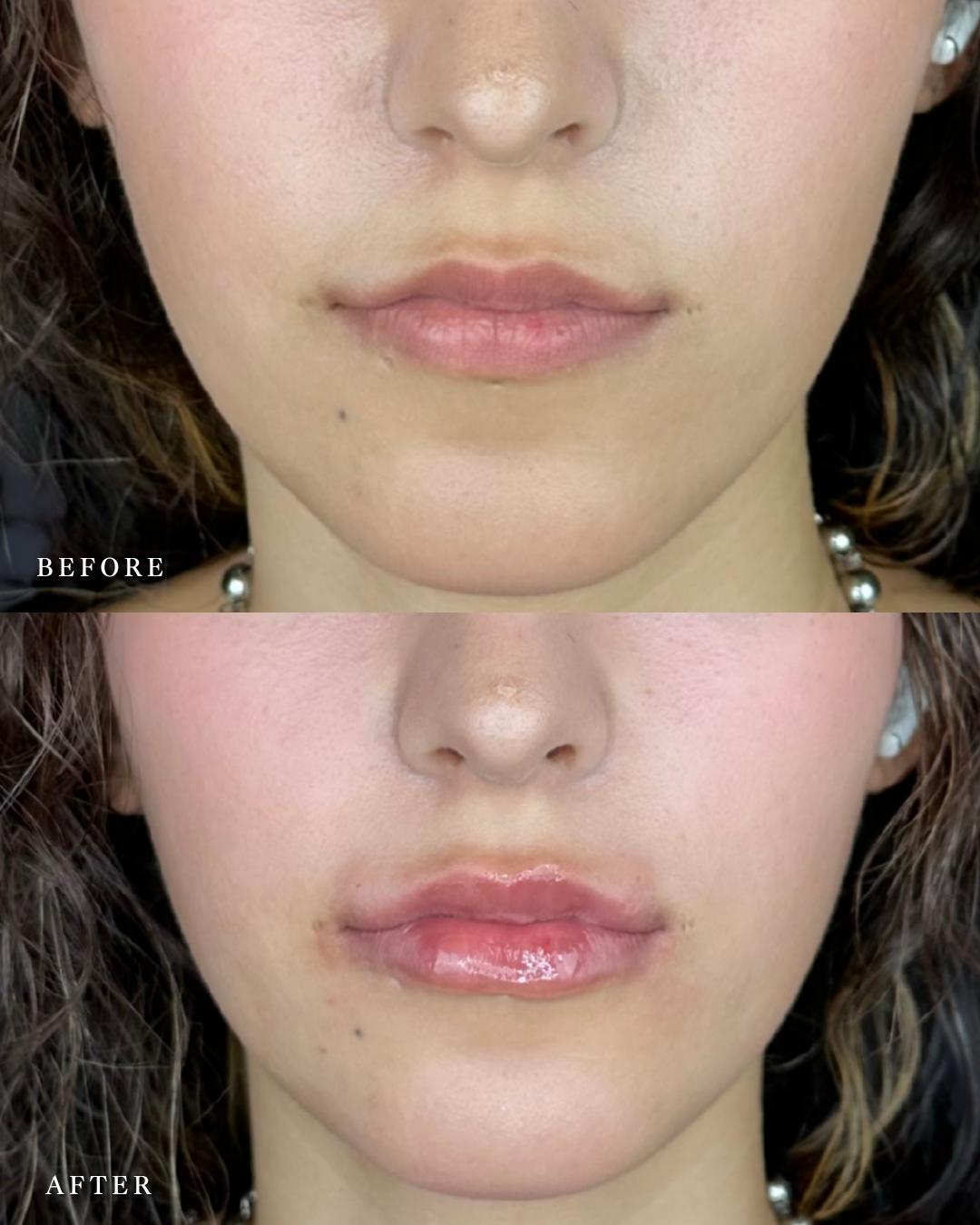 Cカールリップの症例写真