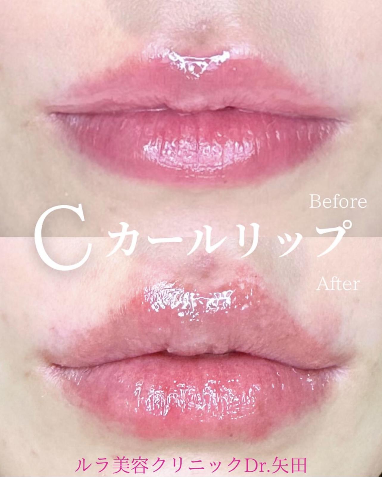 Cカールリップの症例写真