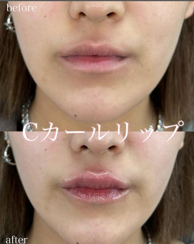 Cカールリップの症例写真