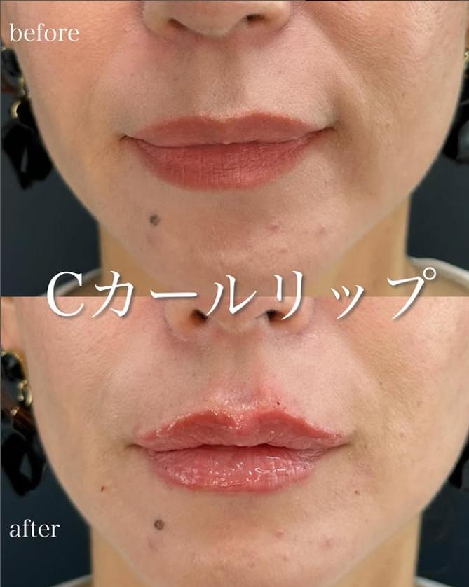 Cカールリップの症例写真