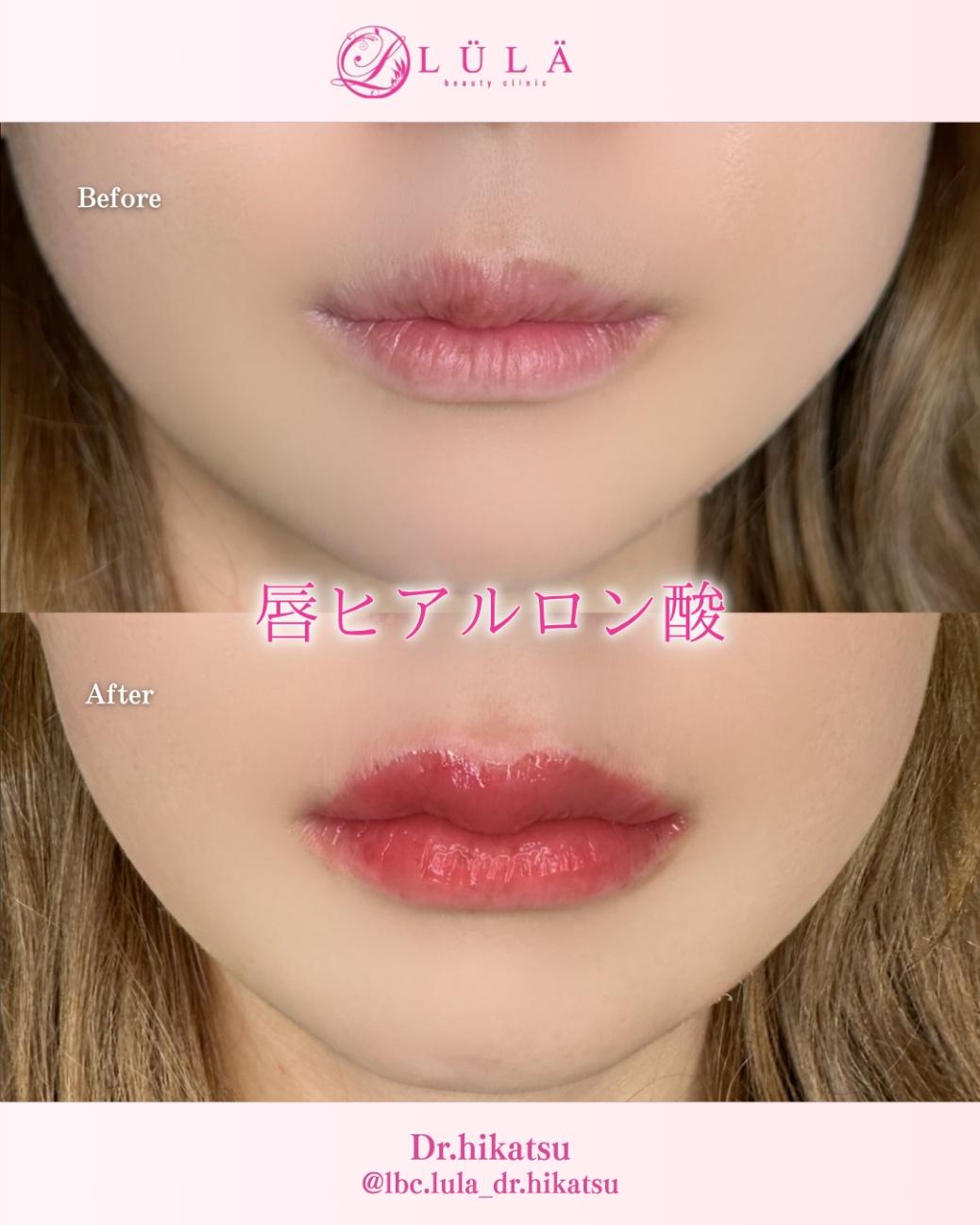 Cカールリップの症例写真