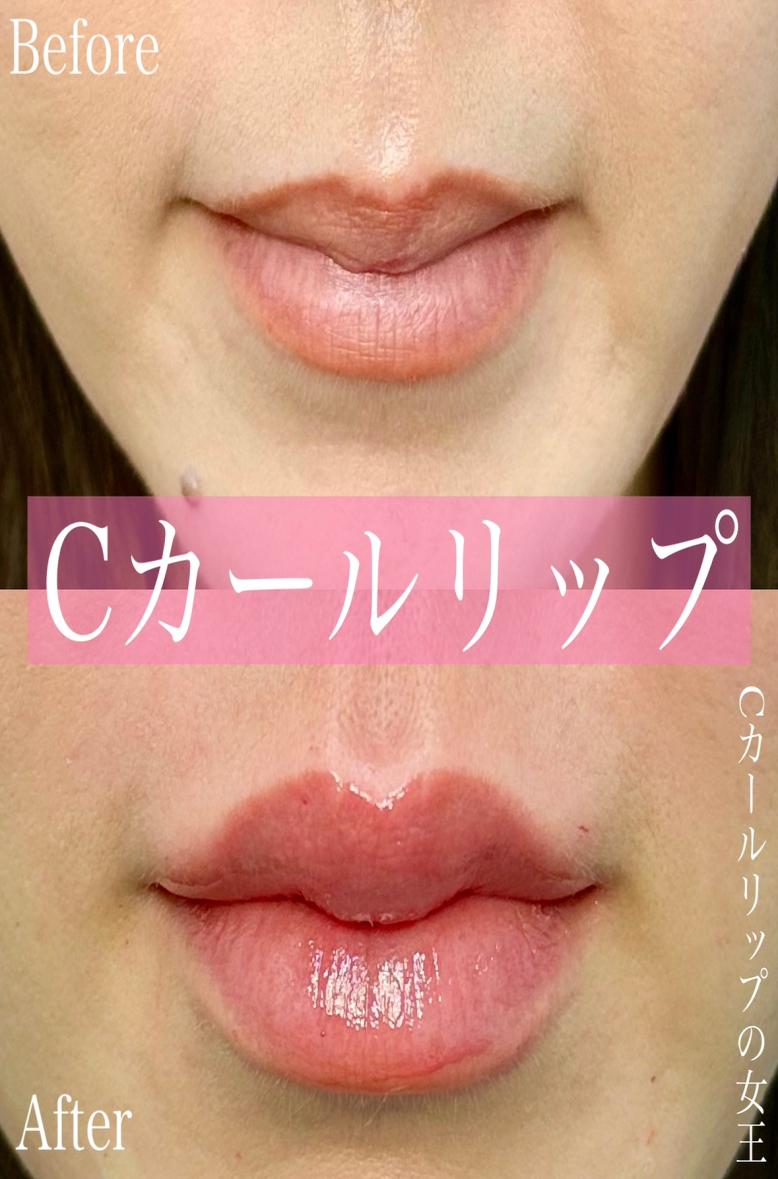 Cカールリップの症例写真