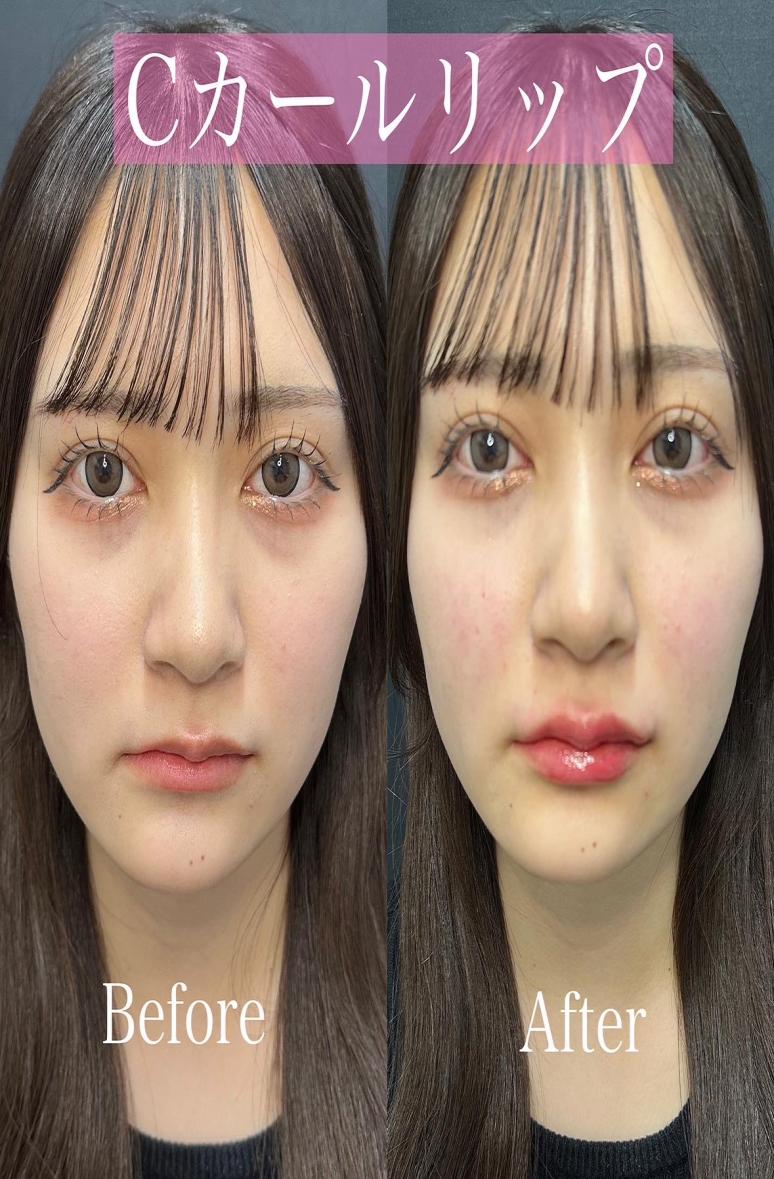 Cカールリップの症例写真