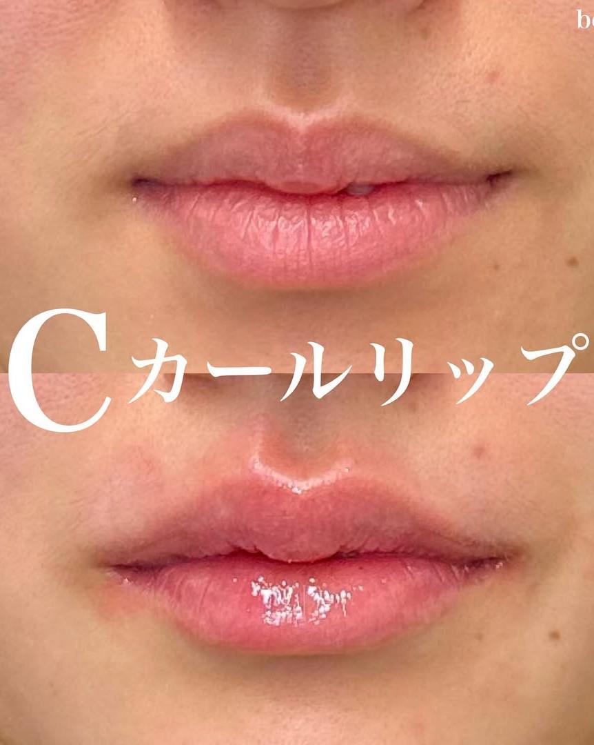 Cカールリップの症例写真