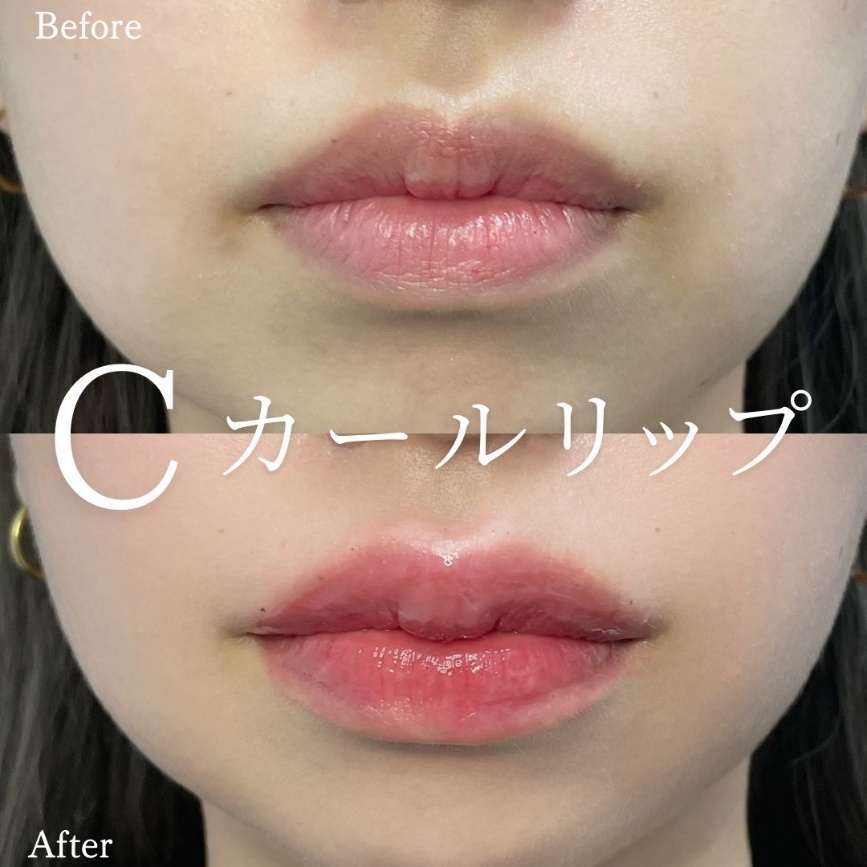 Cカールリップの症例写真