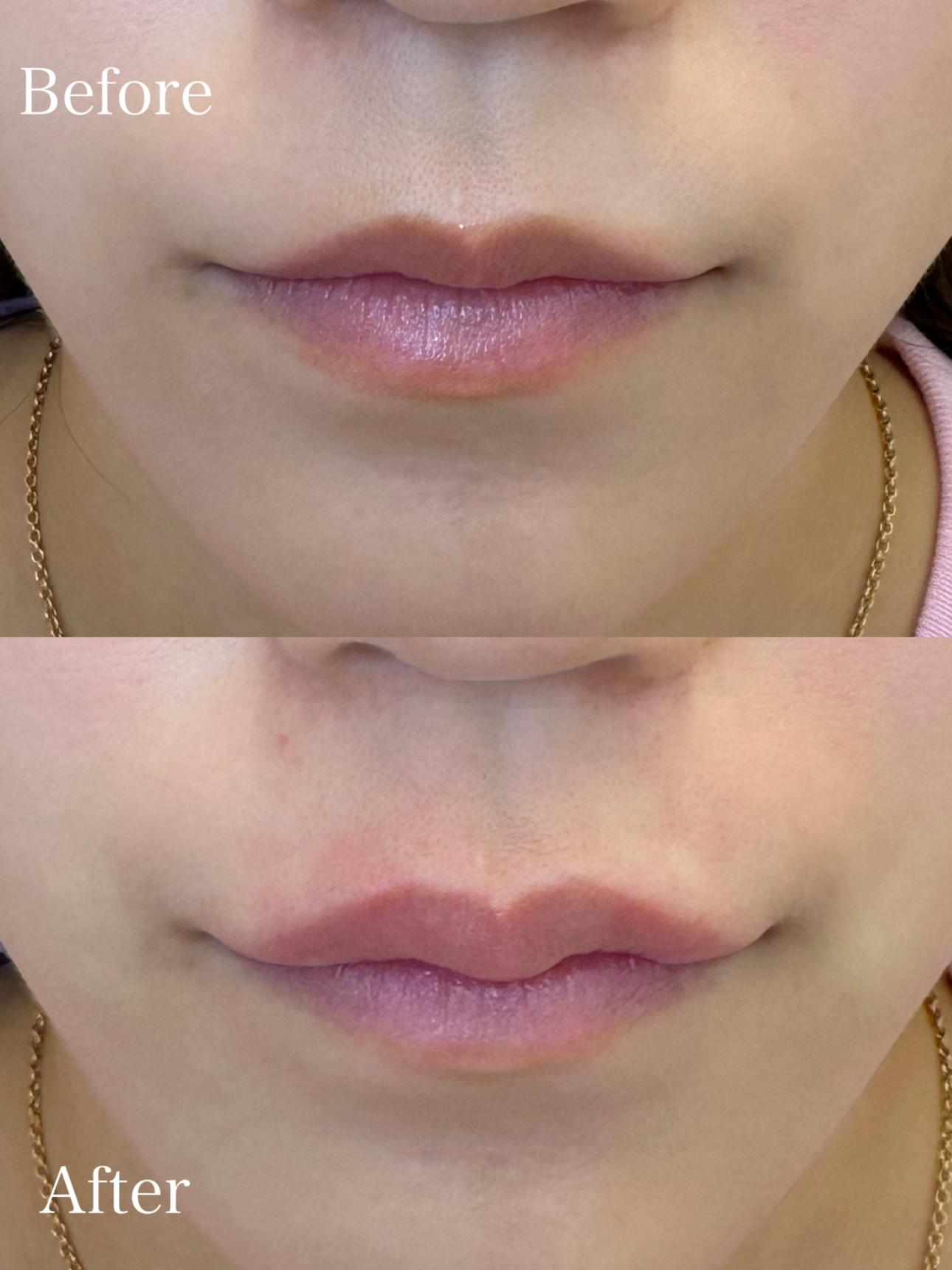 Cカールリップの症例写真