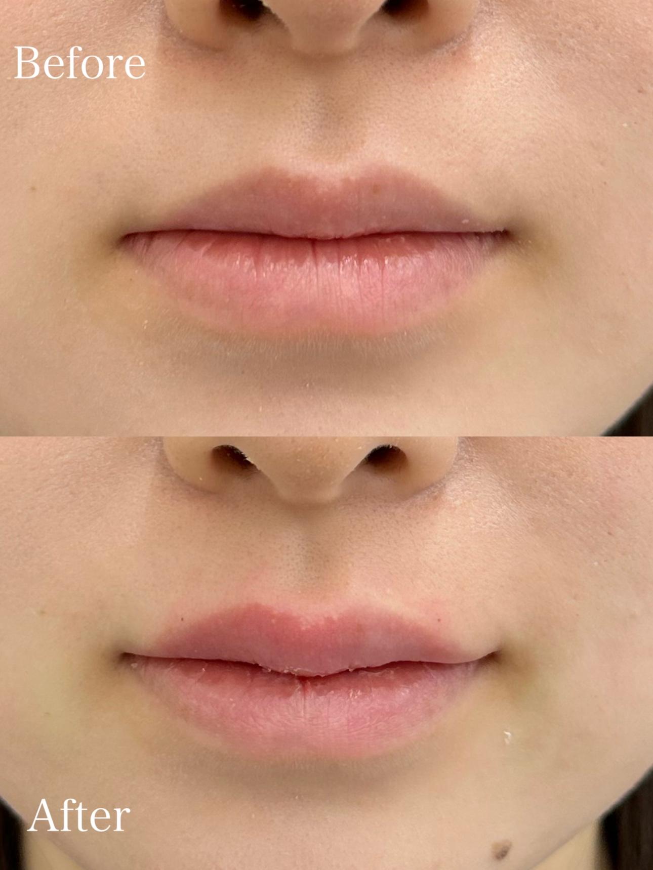 Cカールリップの症例写真