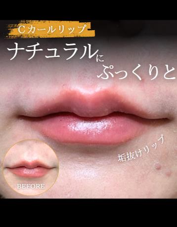 Cカールリップの症例写真