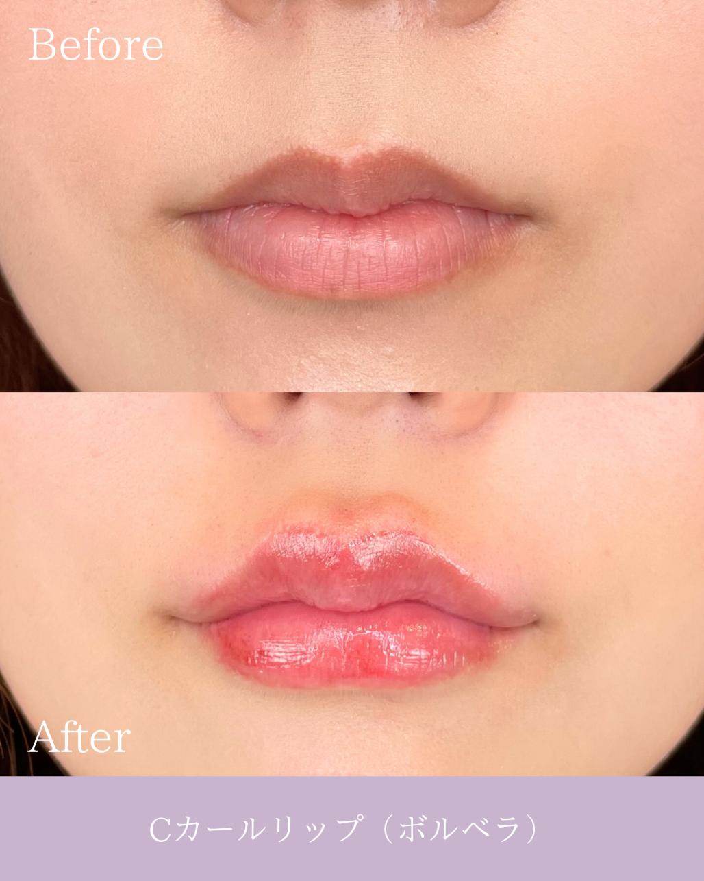 Cカールリップの症例写真