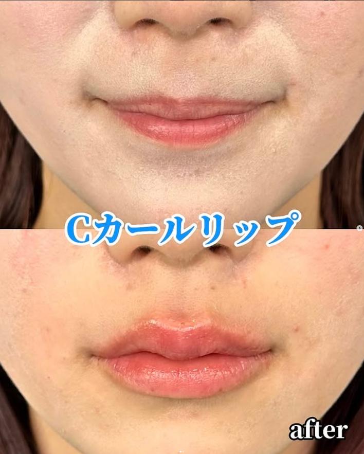 Cカールリップの症例写真