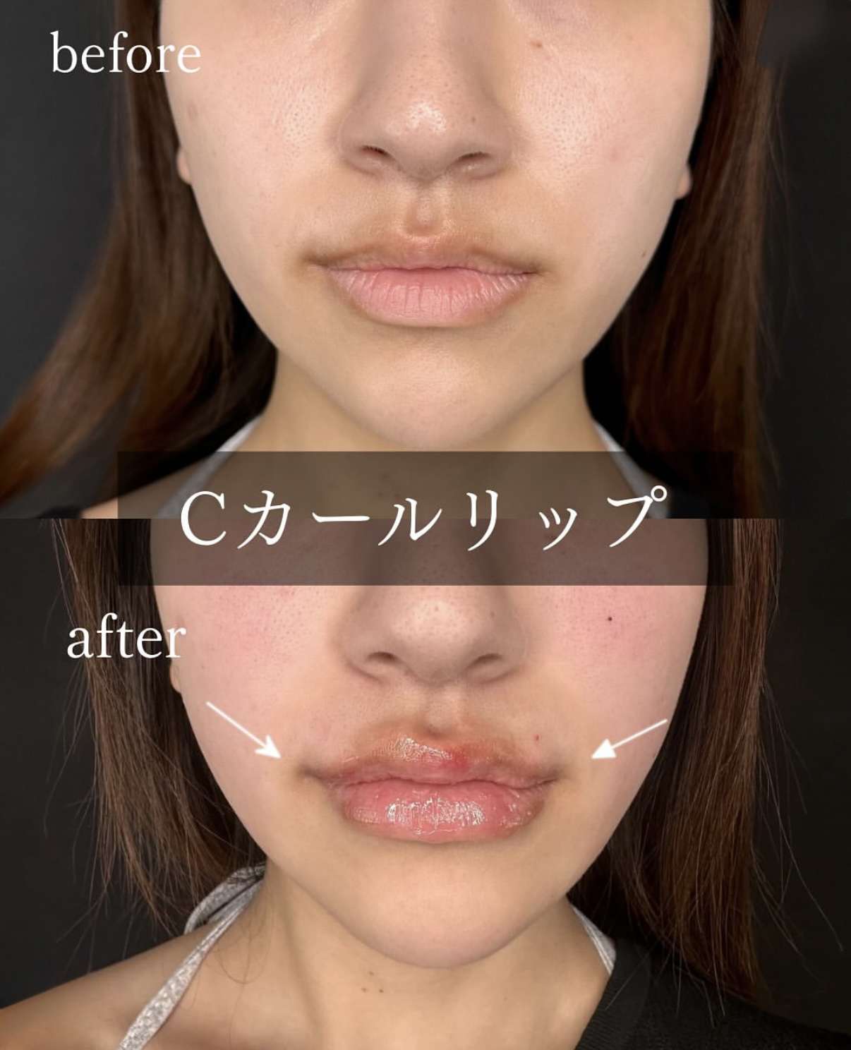 Cカールリップの症例写真