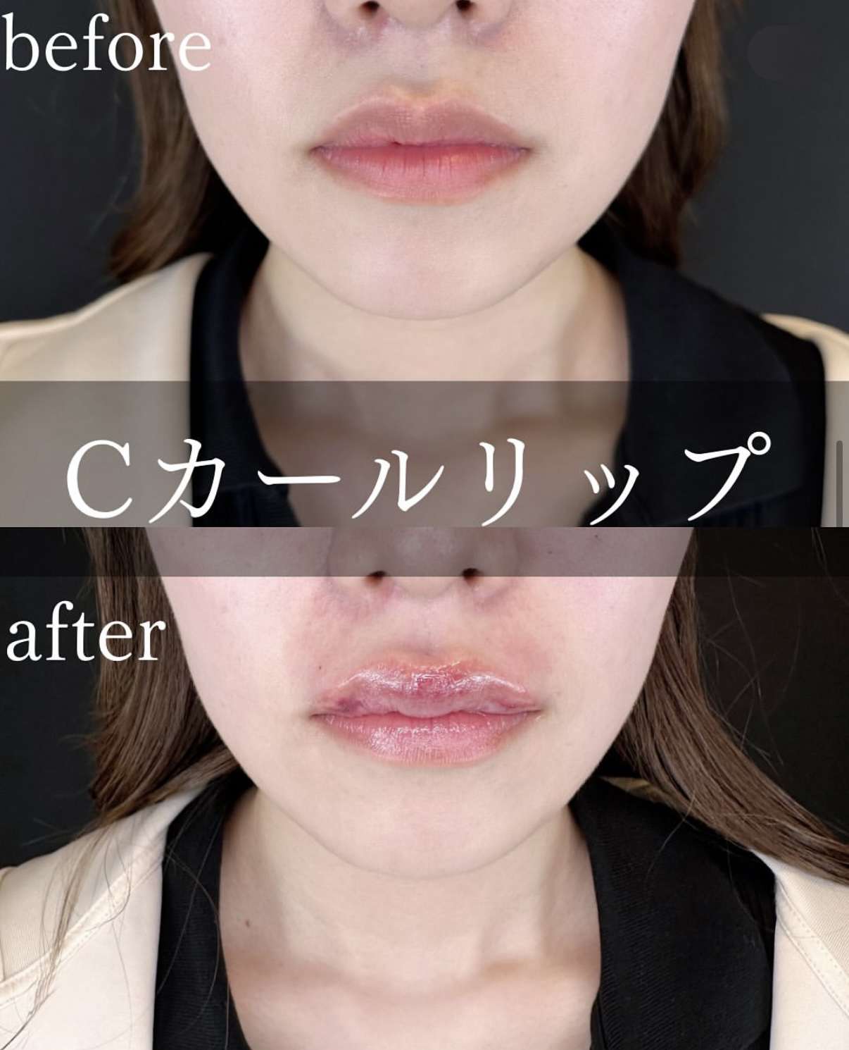 Cカールリップの症例写真