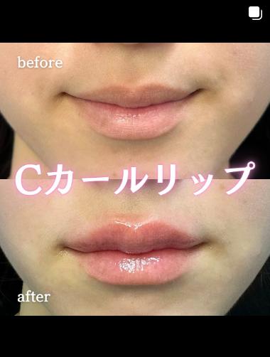 Cカールリップの症例写真