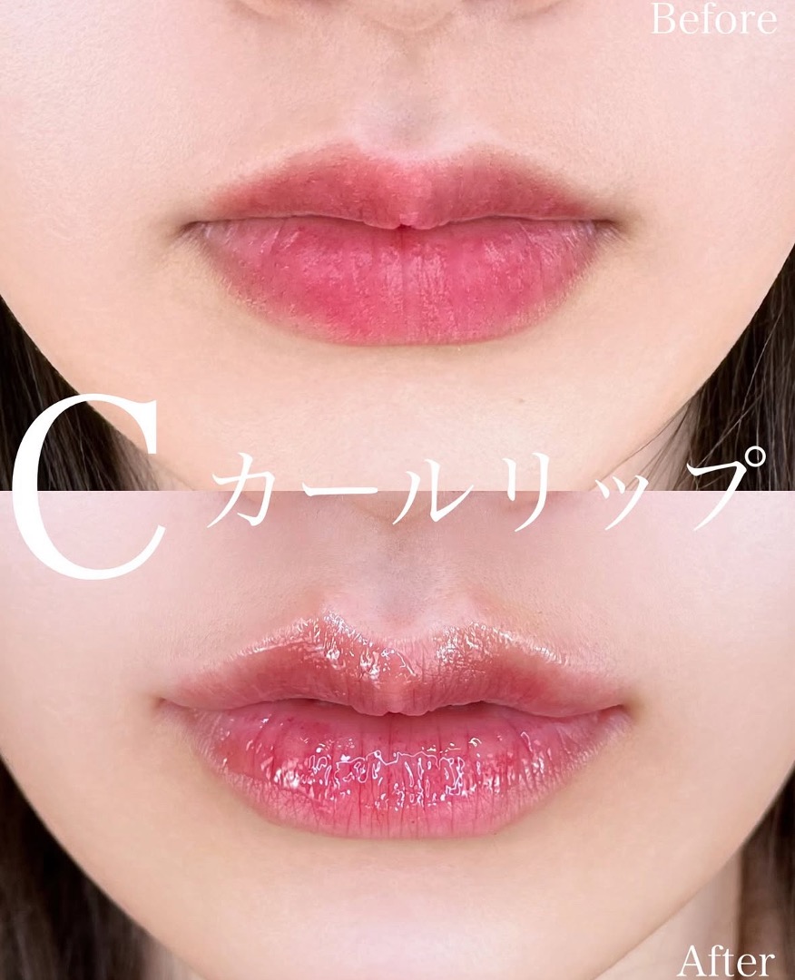 Cカールリップの症例写真