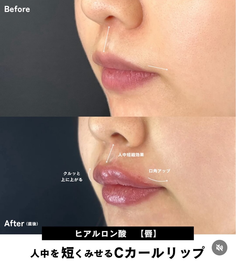 Cカールリップの症例写真