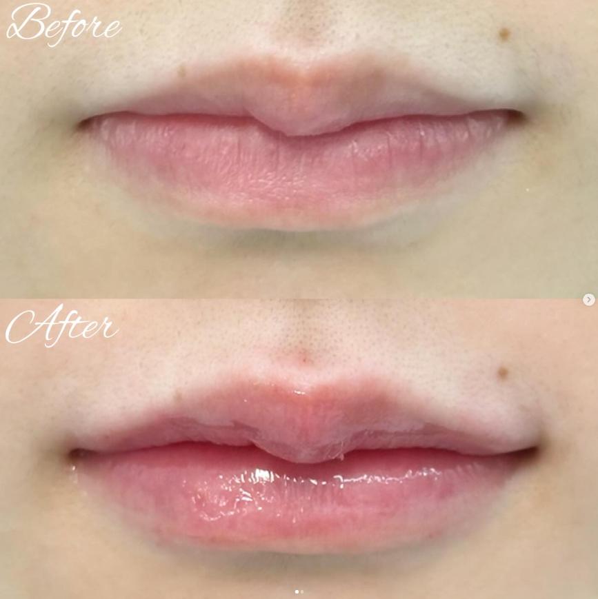 Cカールリップの症例写真