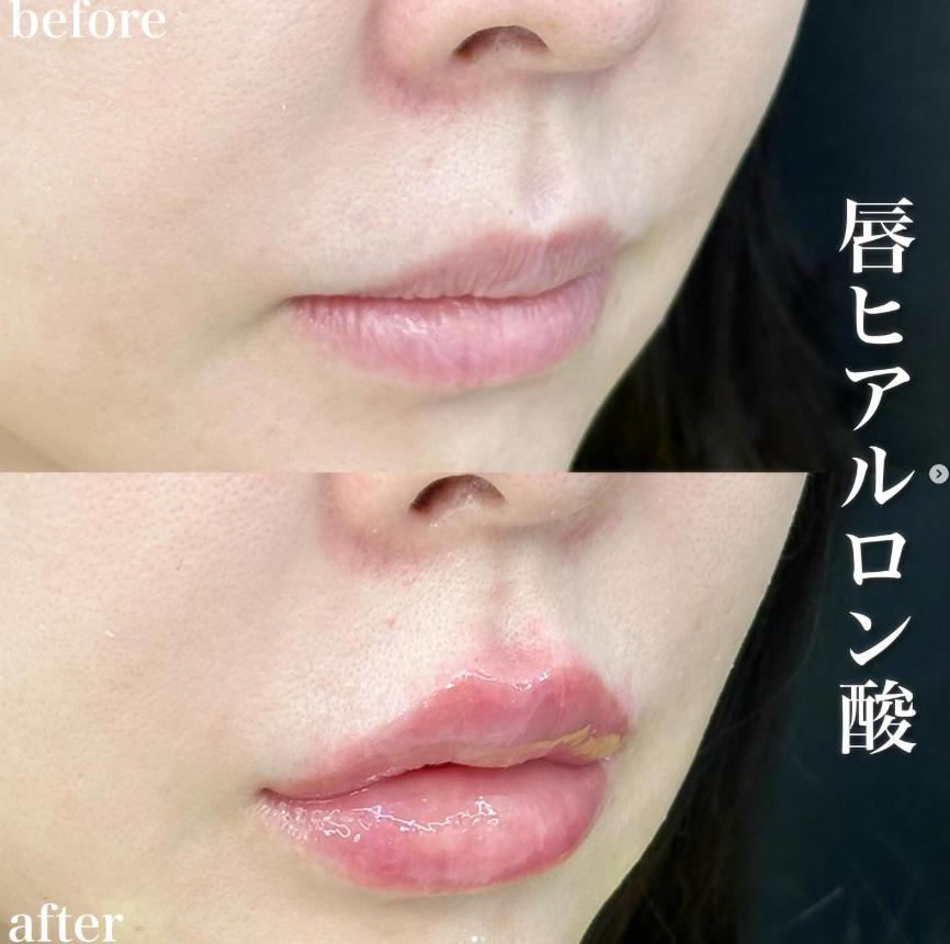 Cカールリップの症例写真