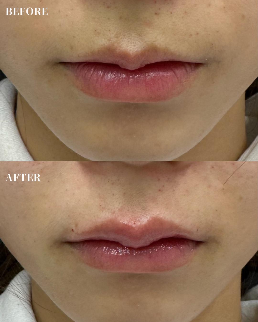 Cカールリップの症例写真