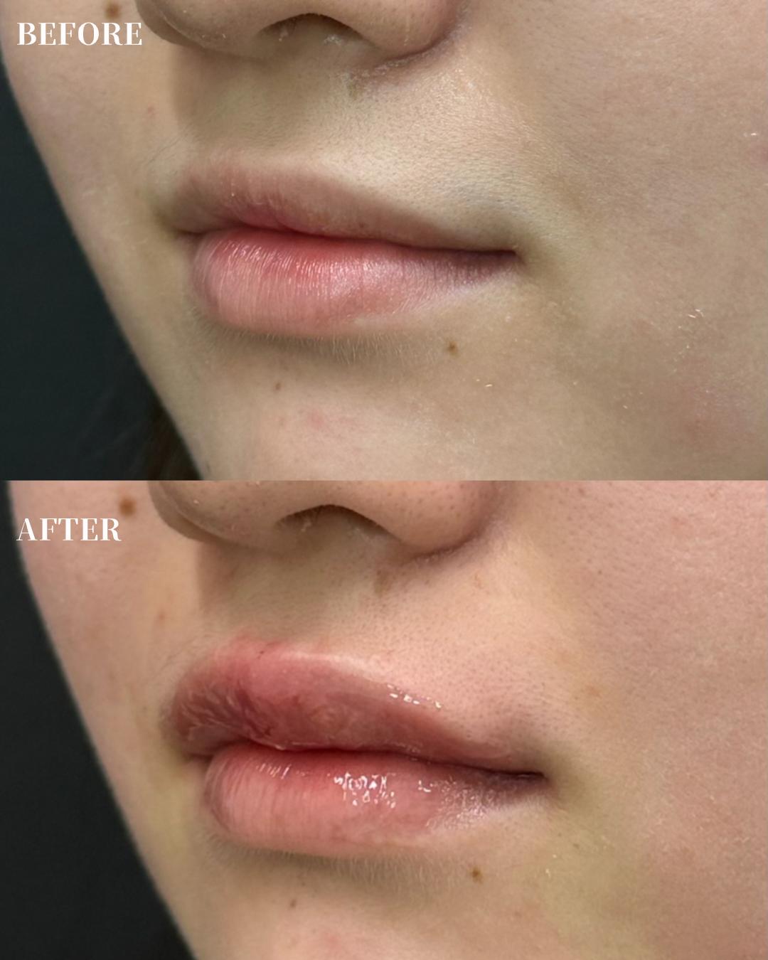 Cカールリップの症例写真