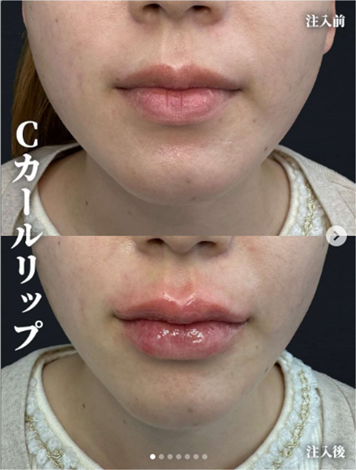 Cカールリップの症例写真