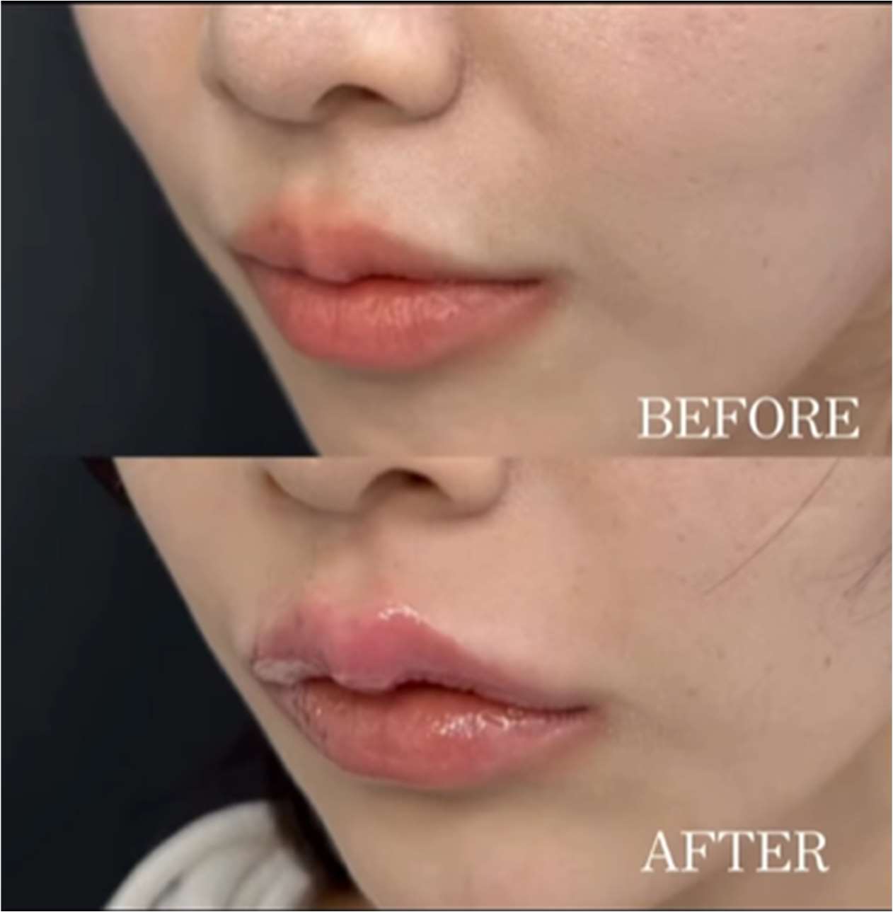 Cカールリップの症例写真
