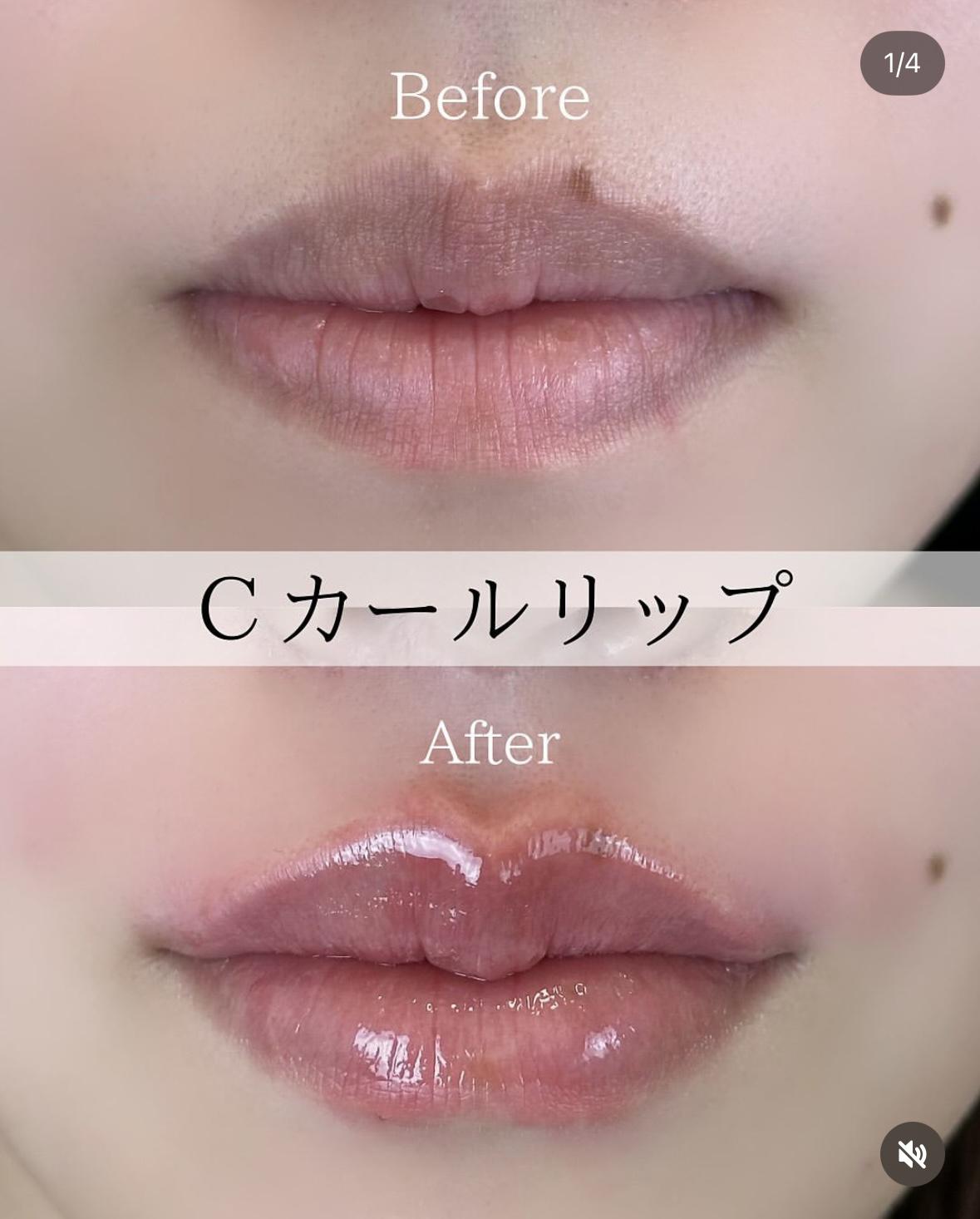 Cカールリップの症例写真