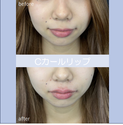 Cカールリップの症例写真