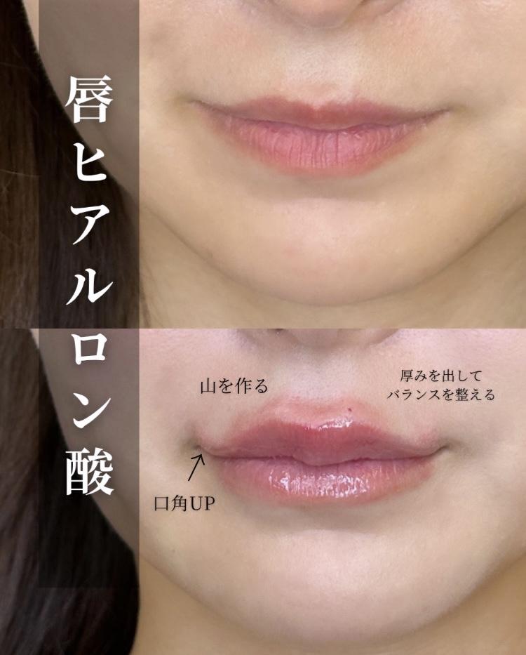 Cカールリップの症例写真