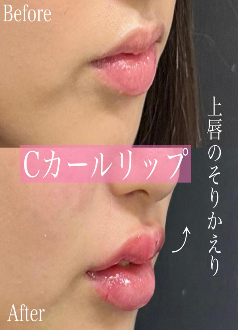 Cカールリップの症例写真