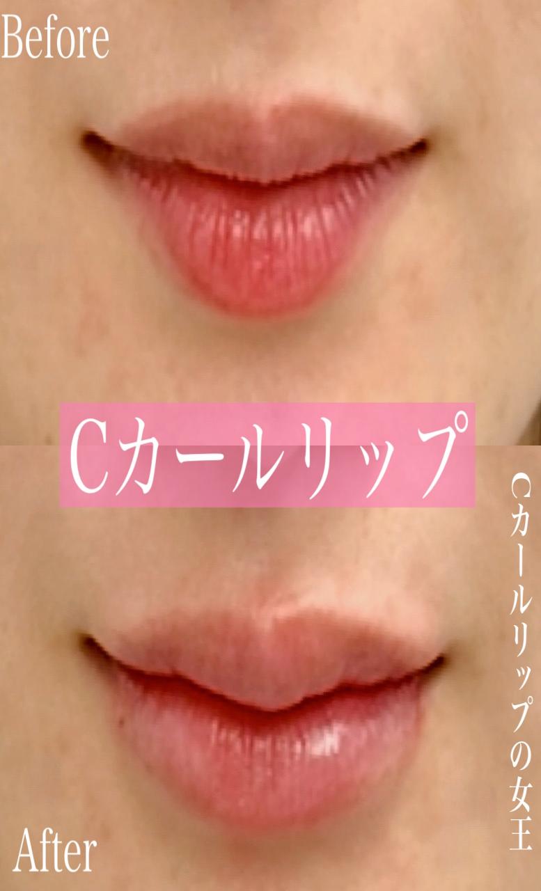 Cカールリップの症例写真