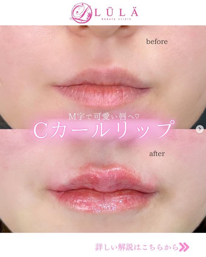 Cカールリップの症例写真