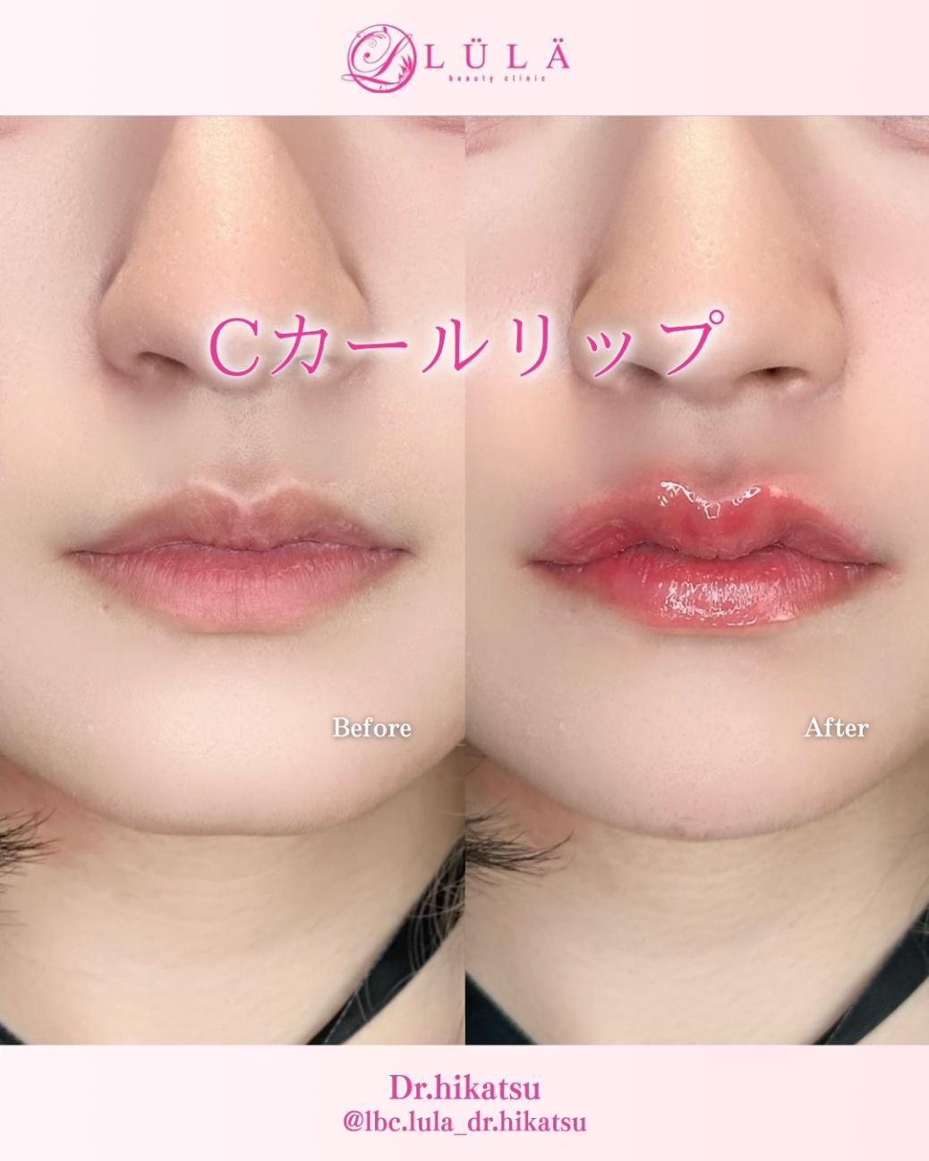 Cカールリップの症例写真