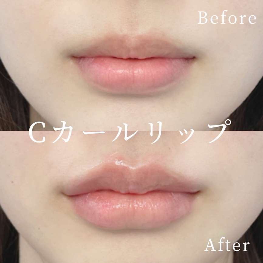 Cカールリップの症例写真