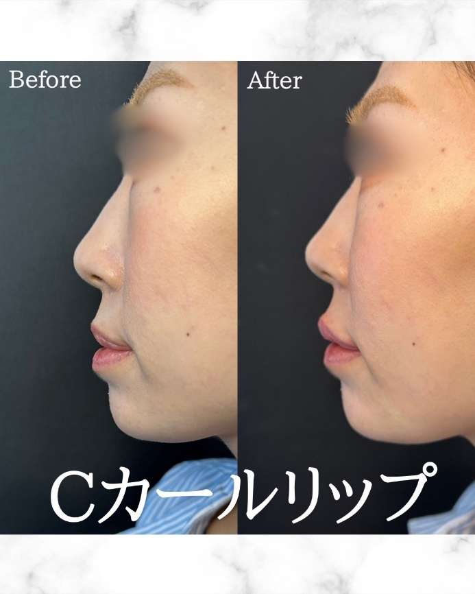Cカールリップの症例写真