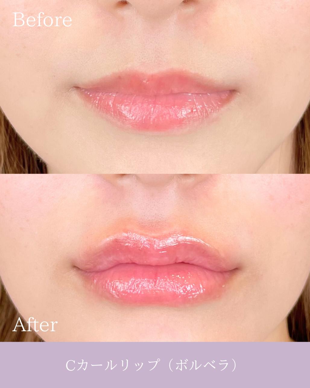 Cカールリップの症例写真