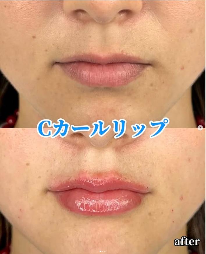 Cカールリップの症例写真