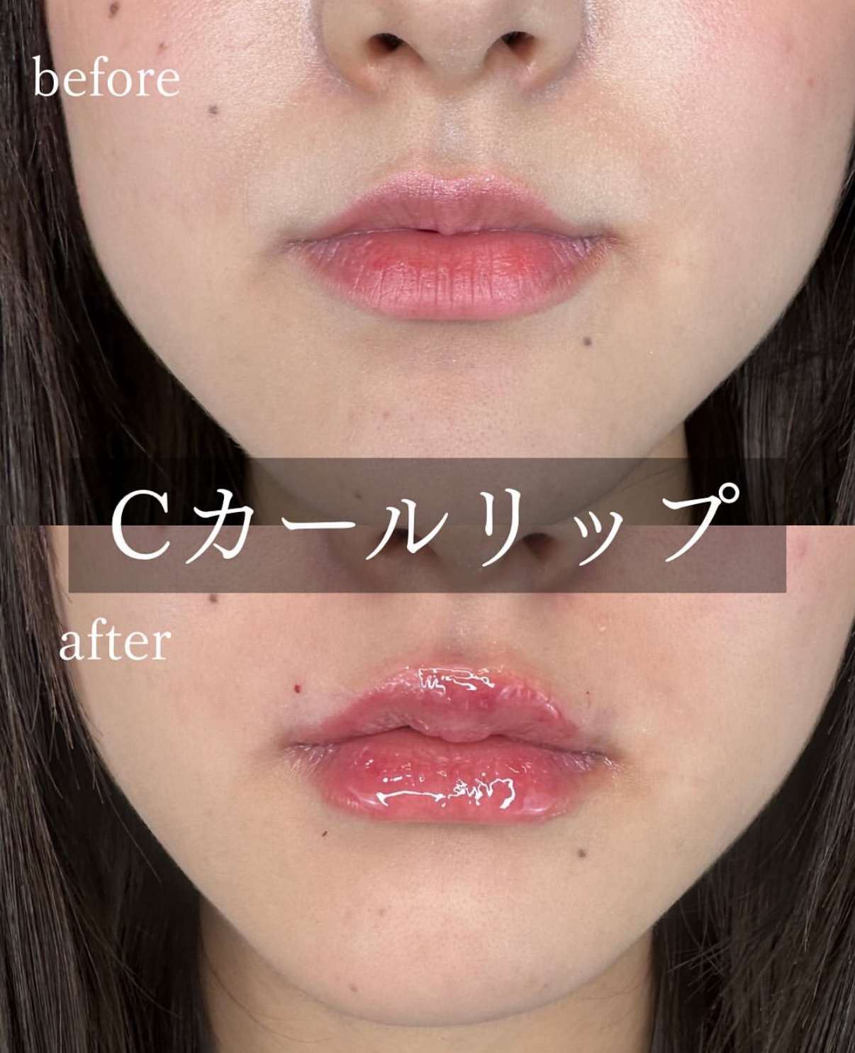 Cカールリップの症例写真
